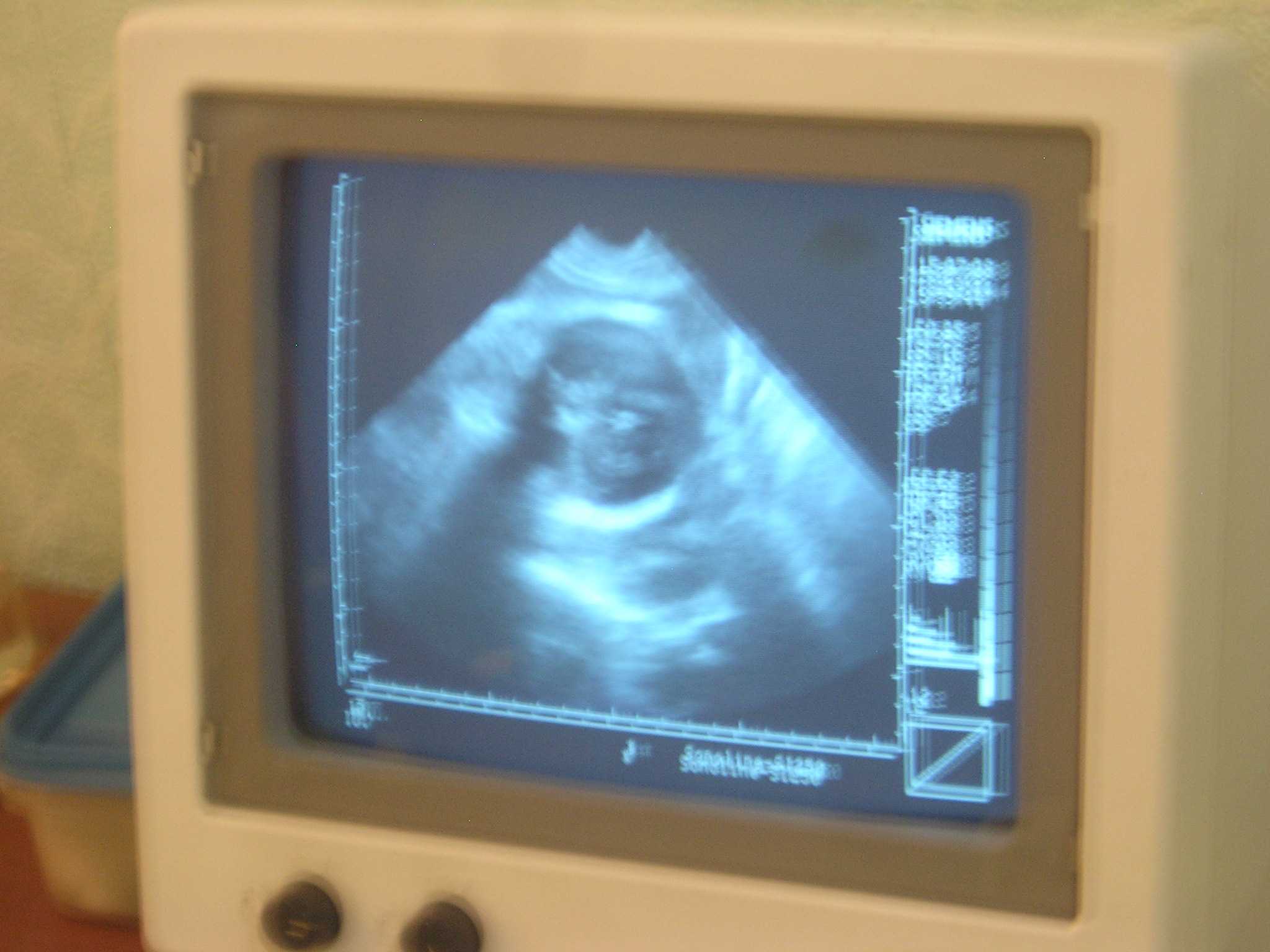08  7 15  Baby US 1, baby is confirmed to be a boy  P7150151